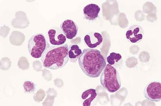 Canine blood. Segmented neutrophils are present but there is a disproportionate number of immature granulocytes present with indented, lobulated, or rounded nuclei. One of the larger cells is a blast form and has multiple nucleoli. RBCs are normocytic and normochromic indicating a nonre- generative anemia. Platelets are markedly reduced. These findings are consistent with chronic granulocytic leukemia (100x). 