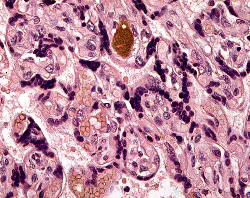 Villi of this hemochorial placenta with syncytial knots and large (brownish) fetal blood vessel. 