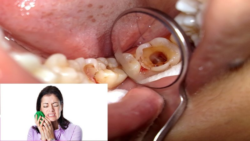 Đau răng ảnh hưởng rất tiêu cực đến tình thần người bệnh