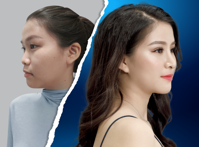 Nâng mũi Hàn Quốc đẹp tự nhiên, chuẩn sao Kpop là phương pháp làm đẹp hạn chế xâm lấn và tối ưu hóa kết quả thẩm mỹ nhất hiện nay.