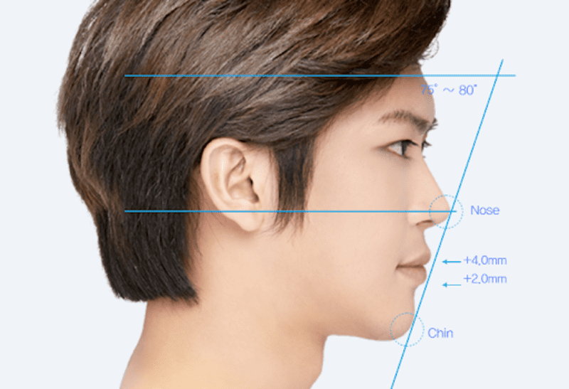 dựa theo kinh nghiệm làm việc nhiều năm của bác sĩ Lee Jung Hoon - Thẩm Mỹ Việt Nam thì nâng mũi nam Hàn Quốc sẽ có những tỷ lệ nhất định