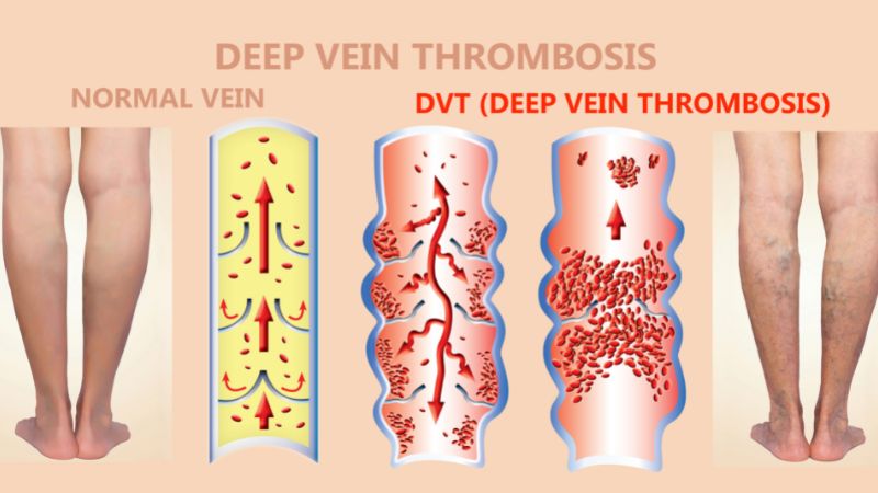 Huyết khối tĩnh mạch sâu