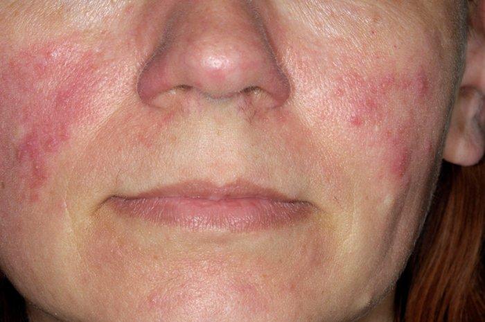 A woman suffering from rosacea
