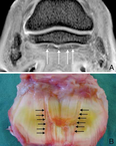 (A) Detail of transverse 3-D T2*-GRE image with fat saturation at the level of the NB of a lame foot.
(B) Frontal view of the DDFT at the level of the navicular bursa in the same foot as A.