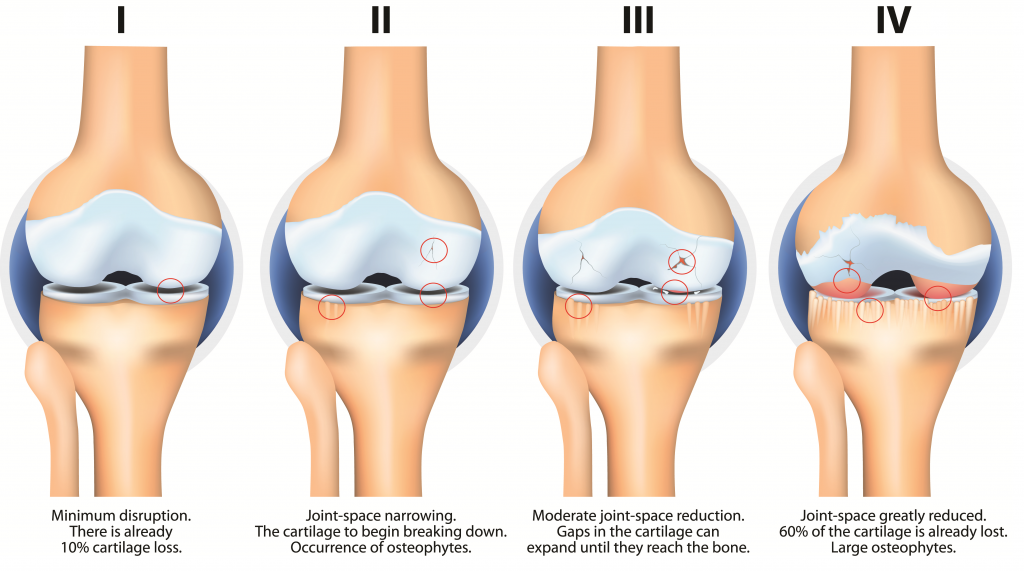 Stem Cells Therapy for Knee Pain