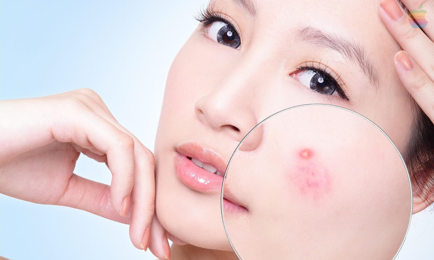 Da mụn mủ, mụn viêm và cách điều trị hiệu quả – Tinh tế Beauty