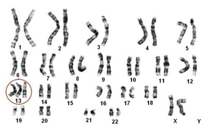 Síndrome de Patau o Trisomía Del Cromosoma