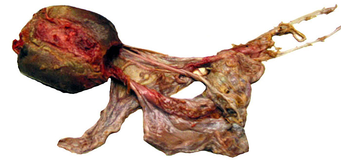 Same placenta (maternal surface) with adjacent disrupted membranes. The central band of subplacental attachment is visible as a raw, red region.