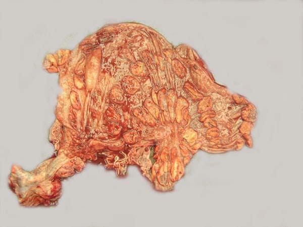 Uterus after removal of the placenta showed the four rows of caruncles