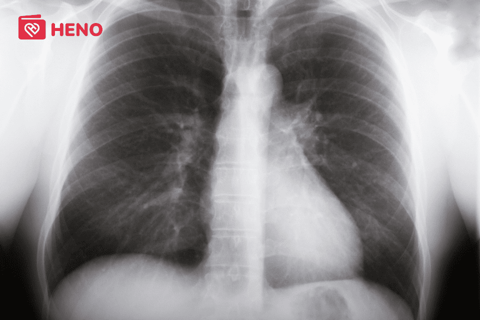 Hình ảnh chụp X-quang của bệnh nhân mắc xơ phổi
