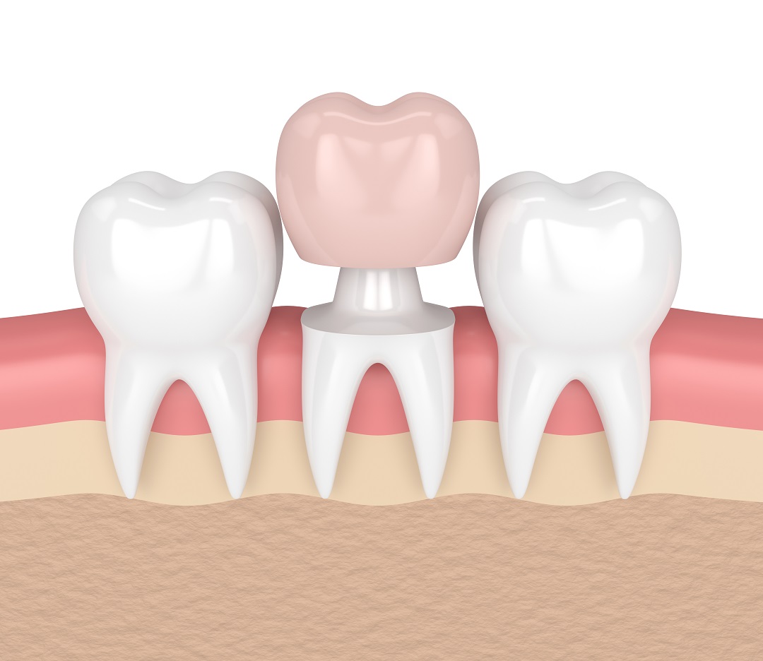 ครอบฟันแบบเซรามิก - The Ivory Dental Clinic