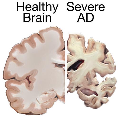 PD-Alzh-brain-.jpg