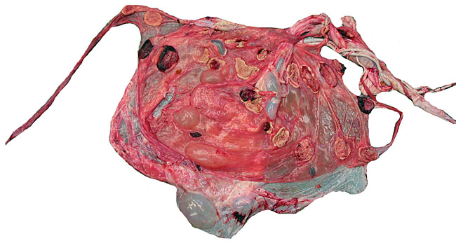 Maternal surface of the same placenta