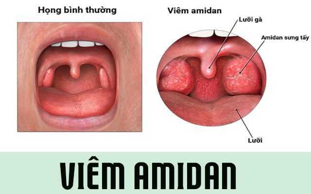 Viêm họng hạt gây biến chứng nguy hiểm