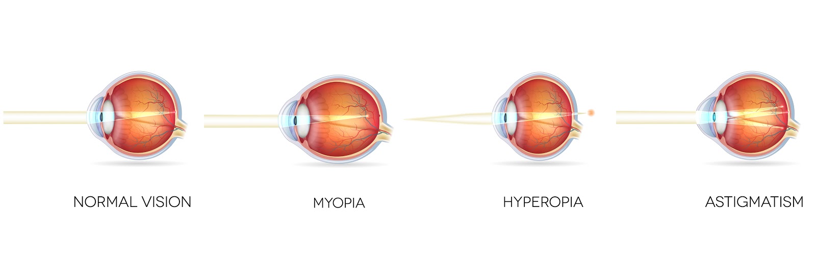 How refractive error effects eyesight