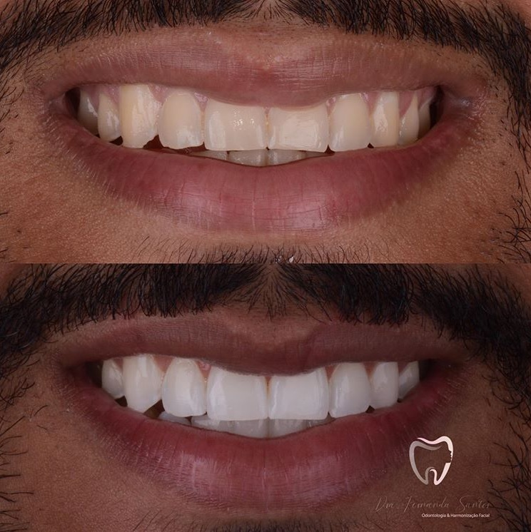 Clareamento Dental Clareamento Dental