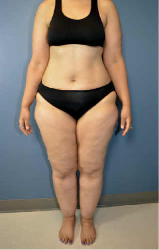C:\Users\User\Downloads\woman-with-lipedema.png