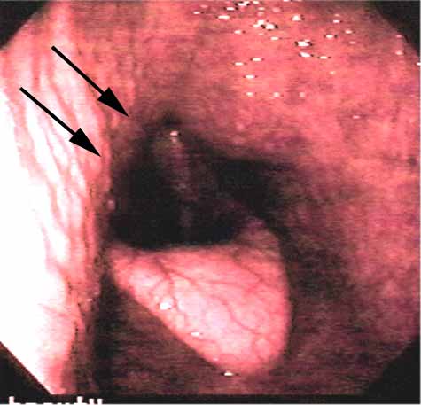 Videoendoscopic image of the nasopharynx of a horse during exercise. Note that the roof of the nasopharynx (arrows) obstructs the view of the corniculate process of the respective arytenoid cartilage.