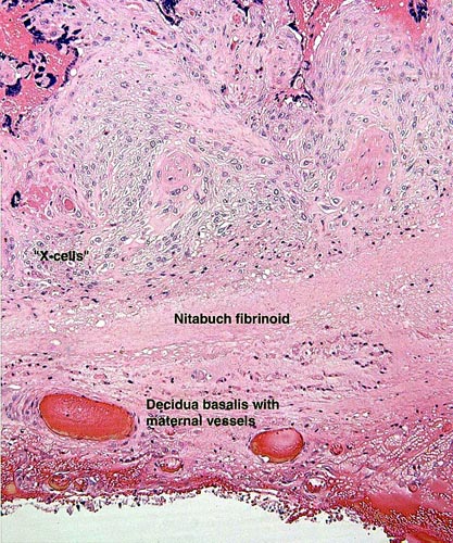 This is the maternal surface with the placental implantation. The large number of invasive extravillous trophoblast attaches to the basal endometrium
