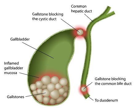 gallstones and problems caused due to them