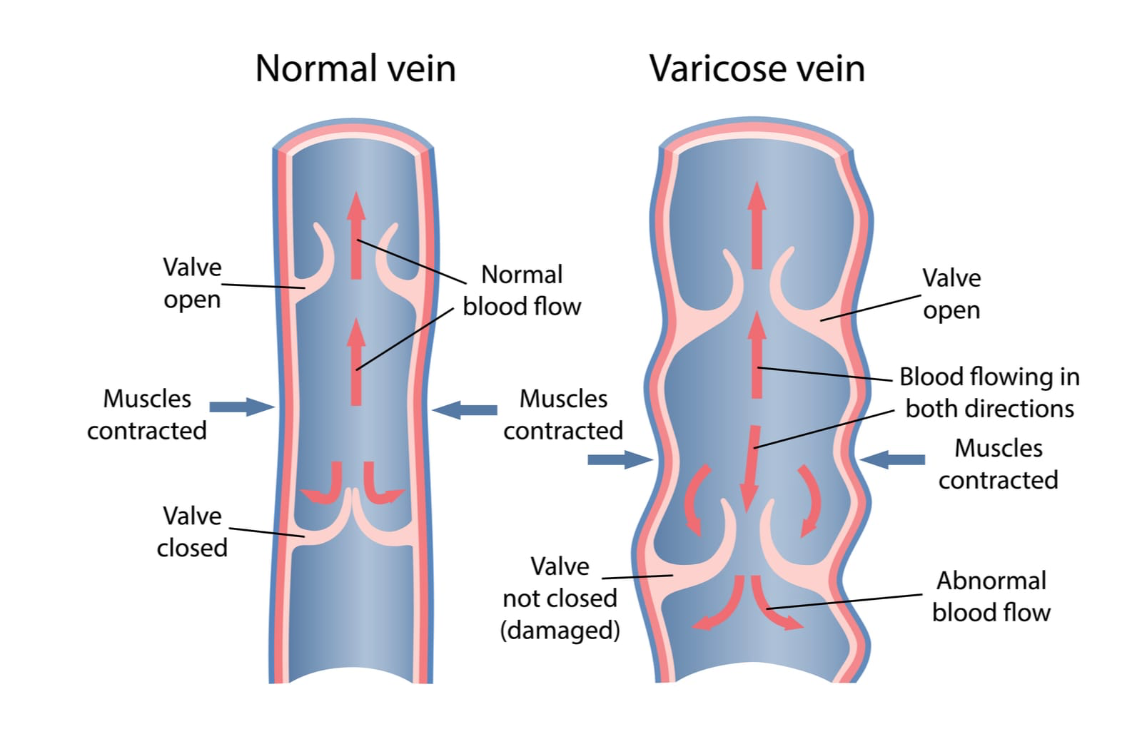 Young woman hiking outside with varicose veins on her leg