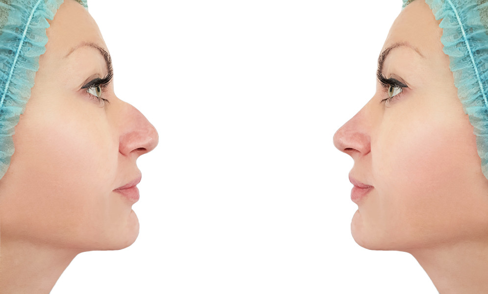 Nâng mũi sụn sườn có an toàn? Một số biến chứng khi nâng mũi sụn sườn bạn nên biết!