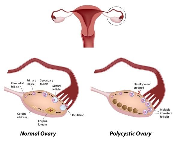 What is Polycystic Ovary Syndrome (PCOS)ichhori.com