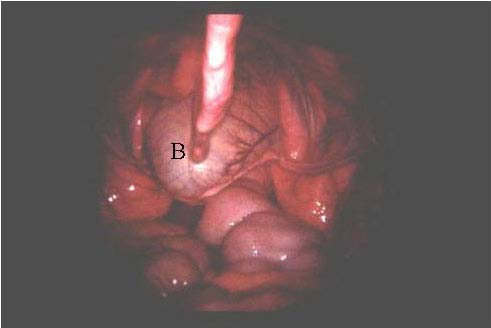 Standing laparoscopy, viewing caudally on left side. B: urinary bladder; Arrow: left lateral ligament of the bladder.