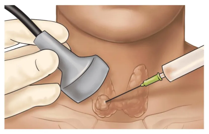 paaf guiada por usg de tireoide - preparaçao para cirurgia de tiroeide

