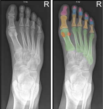 Anatomia do antepé: falanges distais (rosa); falanges médias (azul); falanges proximais (amarelo); metatarsos (verde) e ossos sesamoides (vermelho). Fonte: Adaptado de Radiopaedia. Dixon, A. Normal foot x-rays. Case study, Radiopaedia.org. https://doi.org/10.53347/rID-36688