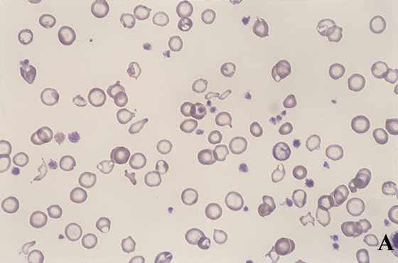 Canine blood. Blood from the dog in Case 6 is compared with normal canine RBCs. A. Microcytosis and hypochromia is pronounced when compared with the normal RBCs in B (40x). 