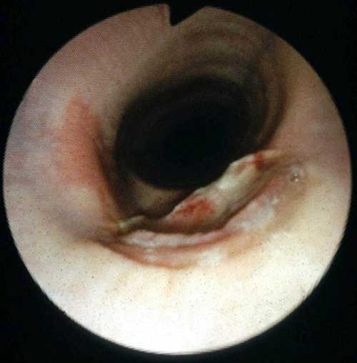 Tracheal granulomas after tracheotomy.
