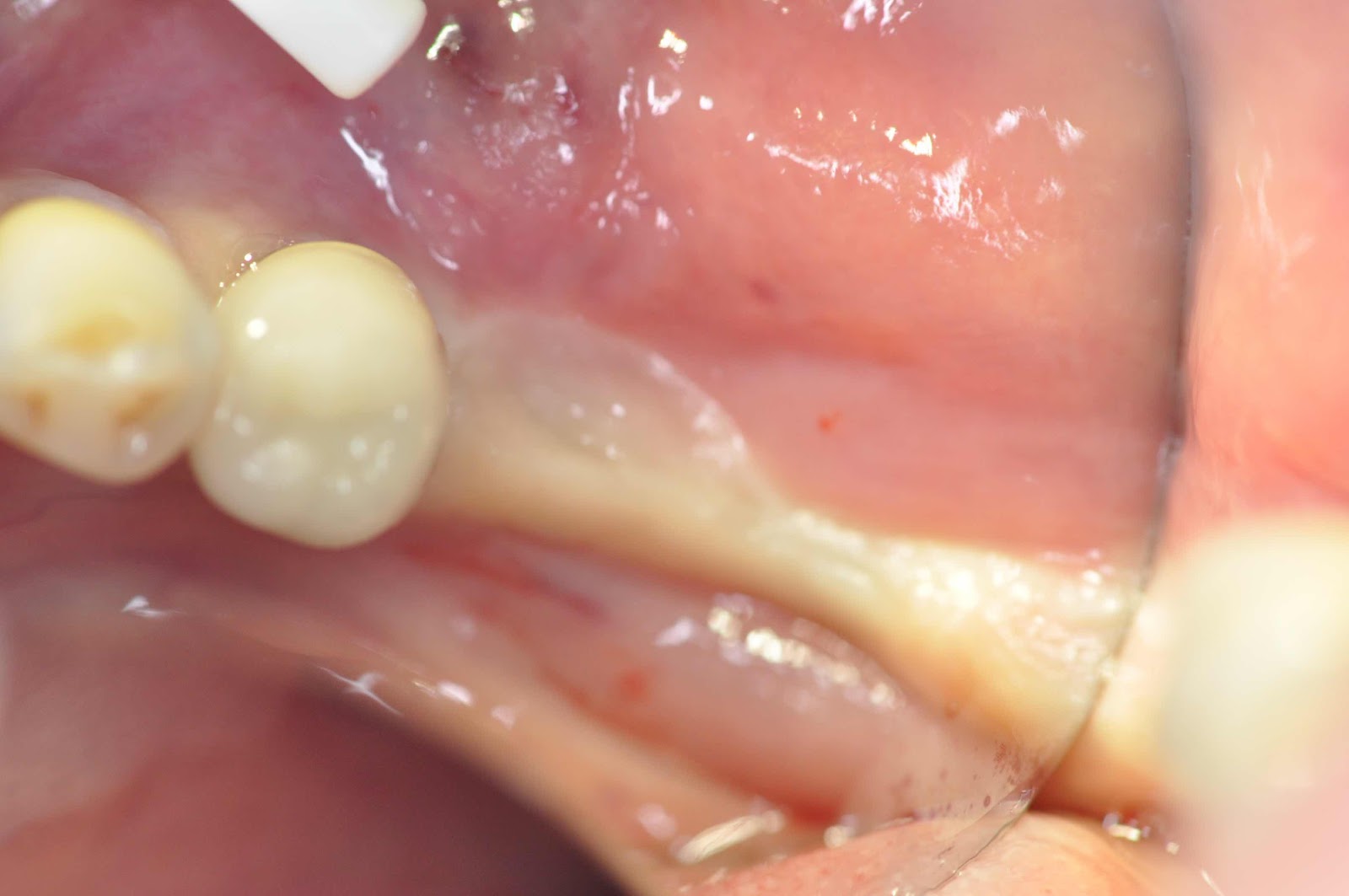 modified Kazanjian Vestibuloplasty for dentalimplant