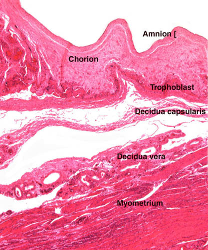 This is the edge of the placenta with the membranes showing a decidua capsularis on the outside