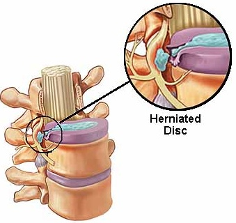 Spinal Fusion Surgery: Risks, Benefits, Recovery & Alternatives for Back  Pain