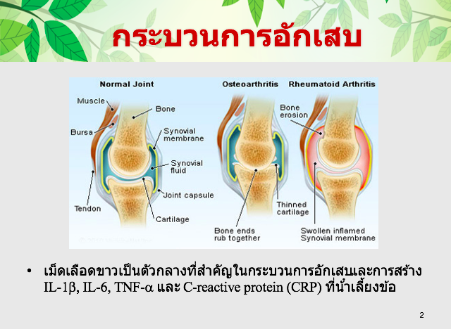 ปวดเข่า