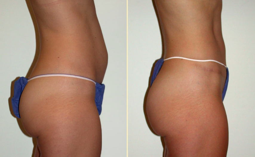 High Lateral Tension Abdominoplasty before and after with Dr. Kiya Movassaghi