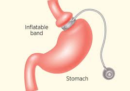 adjustable gastric banding