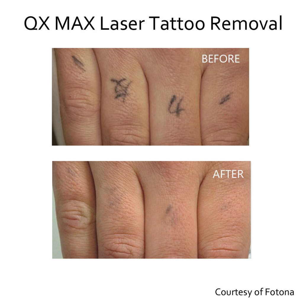 The Rabbit Room Tattoo Removal | Profile |