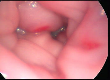 Hemorrhages visible with hysteroscopy in two locations in a buffalo uterus. 