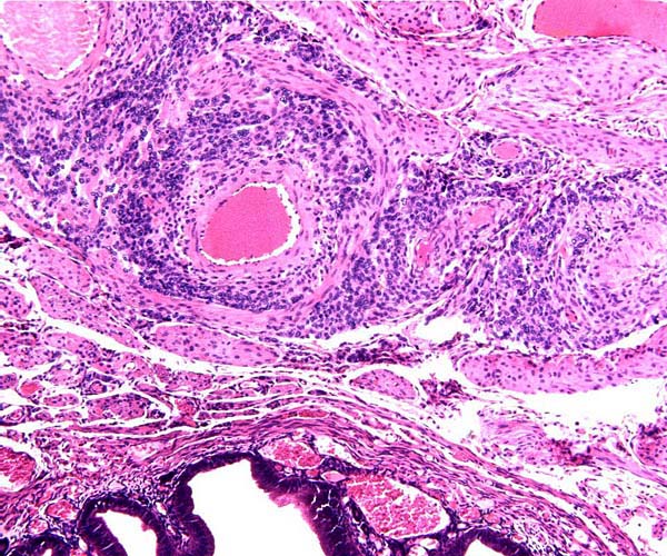 Dark trophoblastic cells surround the uterine arteries.