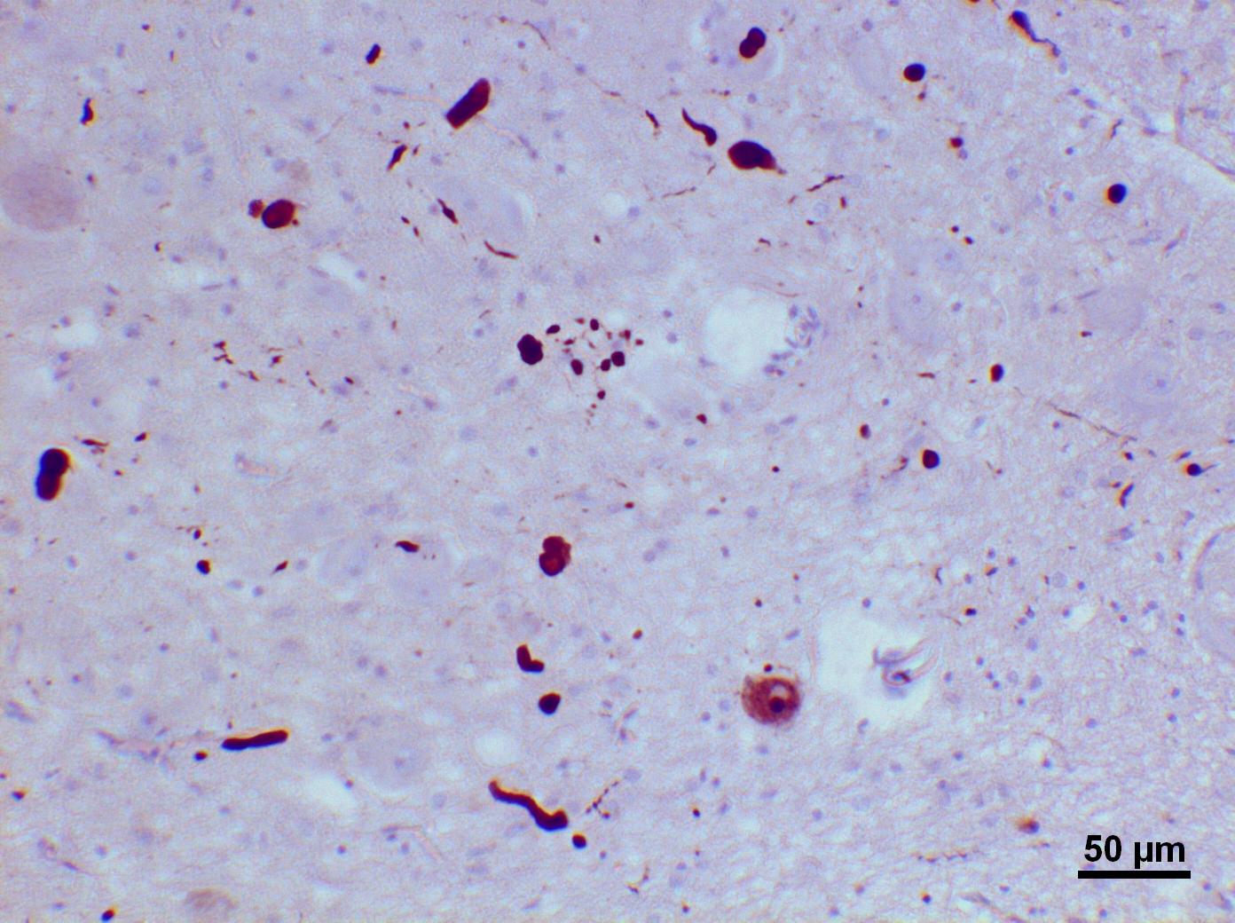 Lewy_bodies_(alpha_synuclein_inclusions)_3.jpg