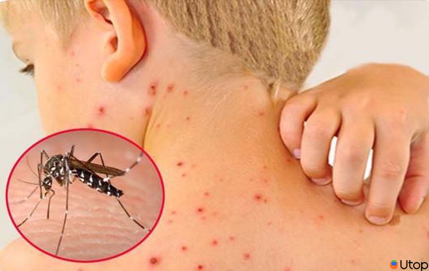 Sốt xuất huyết có nguy hiểm không? Ăn gì mau khỏe?