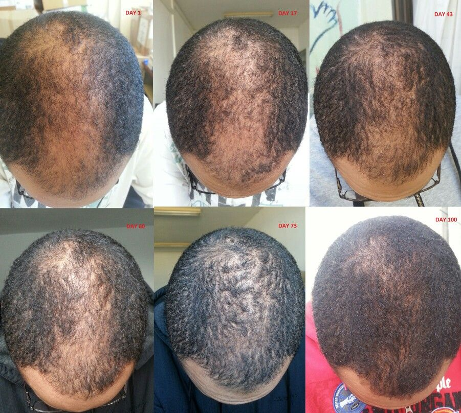 hair loss before after 100 days using minoxidil