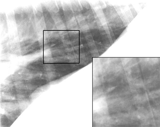 A right lateral radiograph of the dorsal caudal thorax of a horse with acute viral pneumonitis. Interstitial infiltration of inflammatory cells is beginning to define small airway walls and is unstructured in most of the interstices, which serves to camouflage detail of large vessels and airways even though the area of the inset is hyper aerated and over exposed (the adjacent diaphragm is flattened and concave) making lung look more normal in that segment.