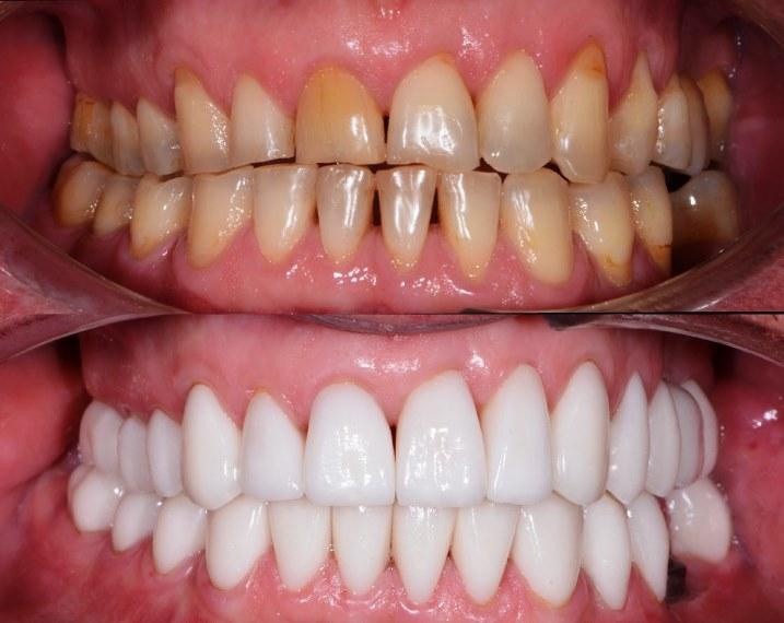Зубы до керамической реставрации и псоле | Фото 4