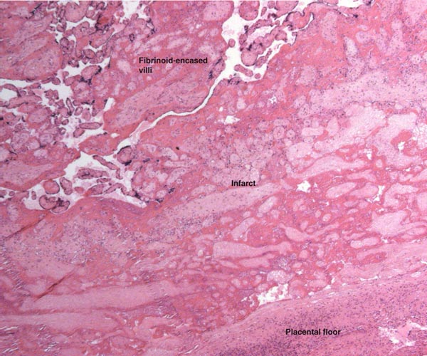 This shows the necrotic, infarcted villous tissue at the placental floor