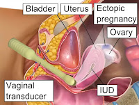 What is an ectopic pregnancy