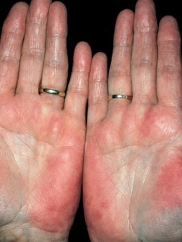 palmar erythema - pictures, photos