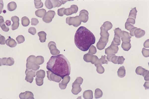 Reactive lymphocytes. Antigenic stimulation produces morphologic changes in feline lymphocytes. Reactive lymphocytes are larger than a neutrophil, vary in size, and have dark blue cytoplasm. Nuclei are rounded with a reticular chromatin and remnants of nucleoli (100x).
